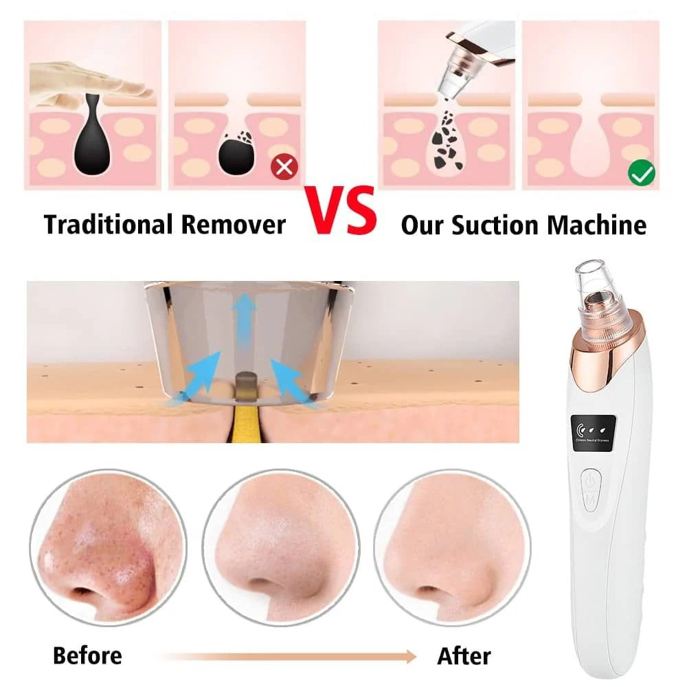 Electric Blackhead Remover | Vacuum Acne & Pore Cleanerl